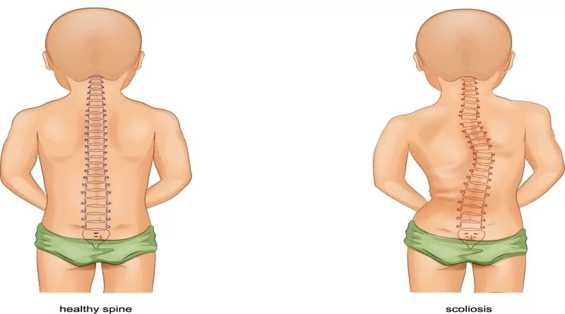 postural deformities