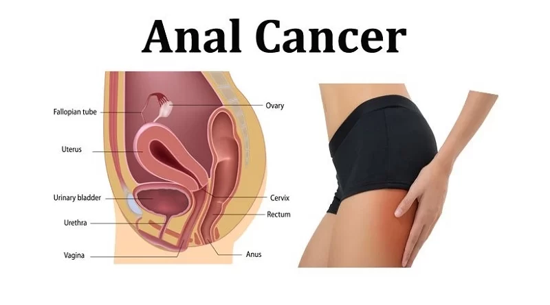 anal cancer