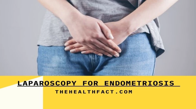 laparoscopy for endometriosis